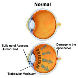 cataract-causes