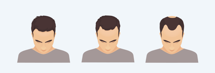 Male Pattern Baldness – Hair Loss in Men – Sunlight Pharmacy