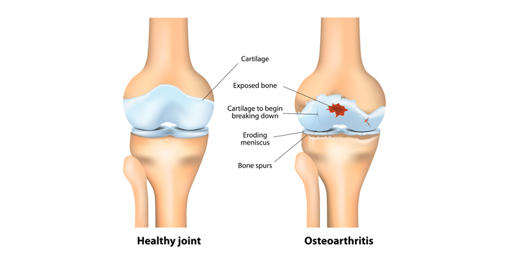 knee-arthritis