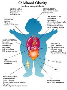 24197074 - childhood obesity