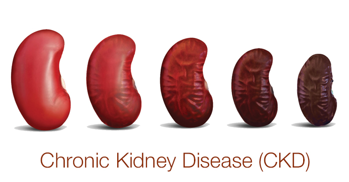 about-chronic-kidney-disease-sunlight-pharmacy