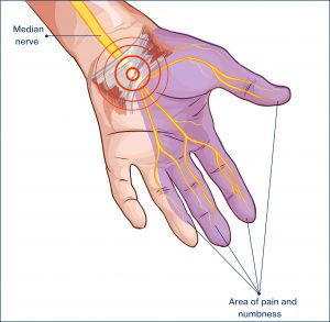 73199850 - transverse carpal ligament compressed median nerve hand