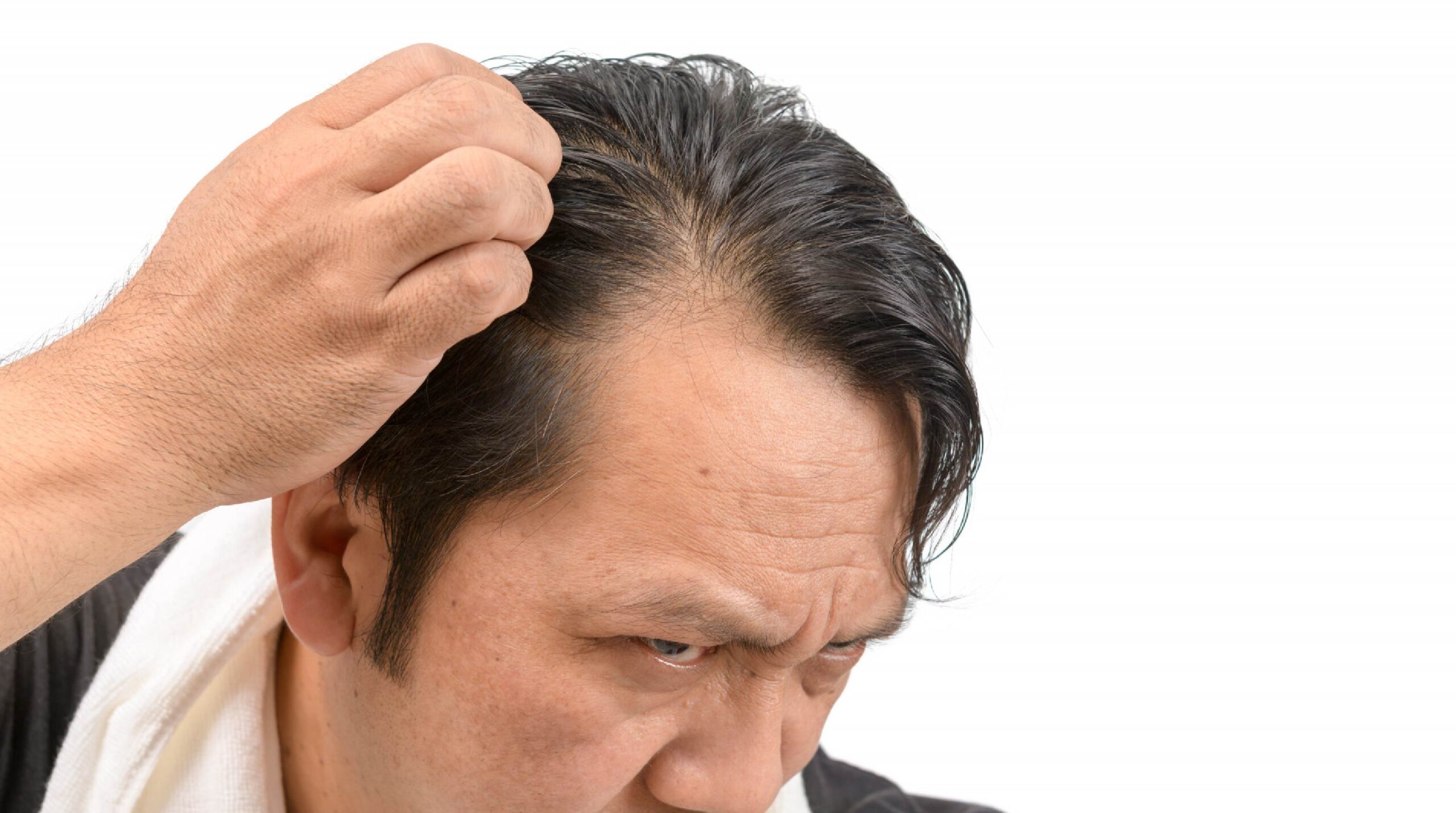 Male Pattern Baldness – Hair Loss in Men
