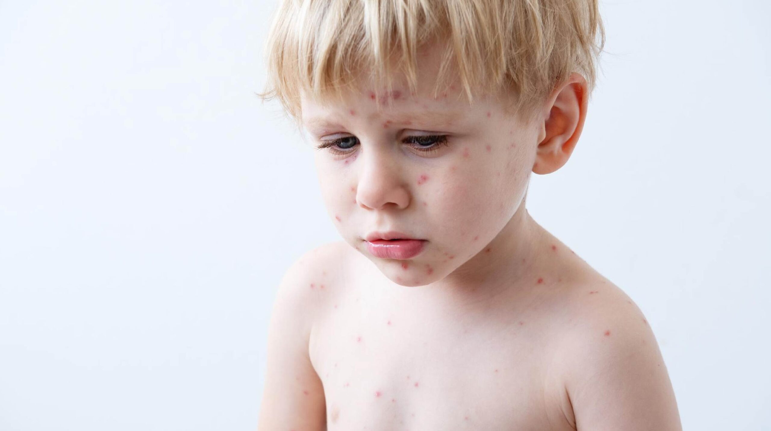 Eczema in Children